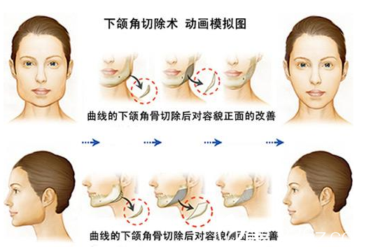 北京南加整形医院下颌角手术示意图