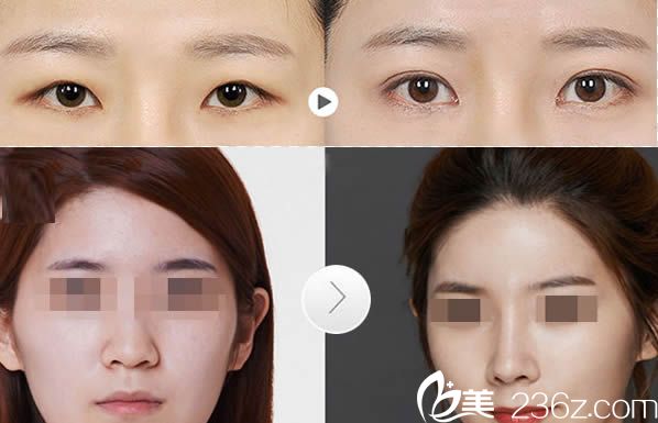 张潮院长双眼皮和假体隆鼻案例 张潮院长双眼皮和假体隆鼻案例