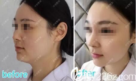 术后即刻的前后对比 术后即刻的前后对比