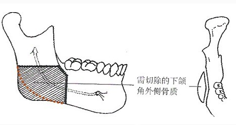 北京南加整形医院下颌角示意图