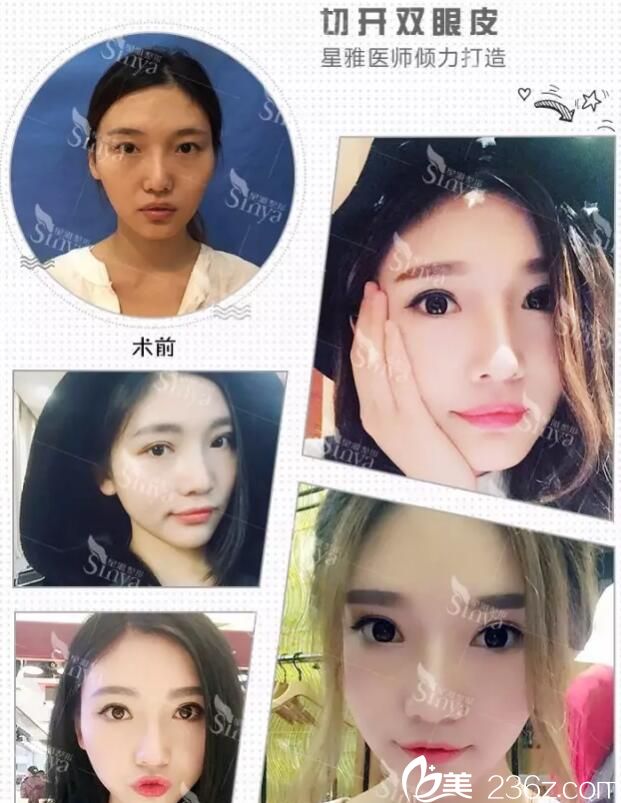 长沙星雅整形双眼皮真人案例 长沙星雅整形双眼皮真人案例