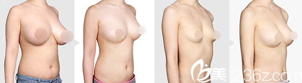 冯春雨胸部整形案例对比照片