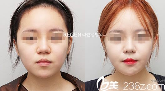 吴铭埈的面部轮廓案例