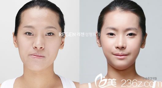 吴铭埈两鄂手术前后效果对比