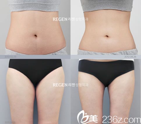 柳志翰院长的吸脂案例图