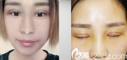 双眼皮术后第3天和拆线后的样子 双眼皮术后第3天和拆线后的样子
