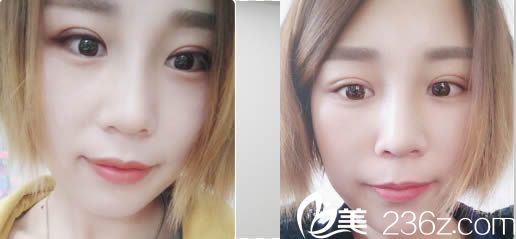 罗德丰鼻综合案例效果图 罗德丰鼻综合案例效果图