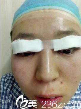 西安同安济医院双眼皮整形真人案例 西安同安济医院双眼皮整形真人案例