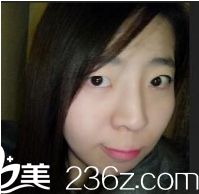 西安同安济医院美容科做双眼皮怎么样？真人案例告诉你