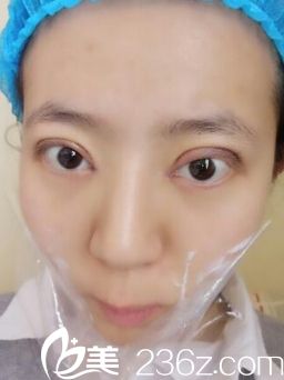 西安同安济医院双眼皮手术恢复后第七天 西安同安济医院双眼皮手术恢复后第七天