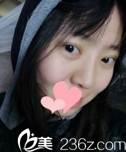 西安同安济医院双眼皮手术恢复后第30天 西安同安济医院双眼皮手术恢复后第30天