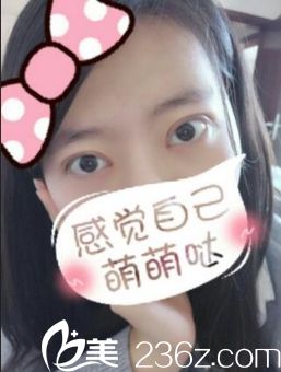 西安同安济医院双眼皮手术恢复后第20天 西安同安济医院双眼皮手术恢复后第20天