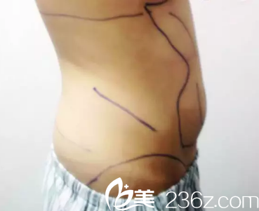 王家林医生为我术前画线 王家林医生为我术前画线