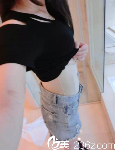 做完吸脂后10天的样子 做完吸脂后10天的样子