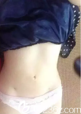 做腰腹吸脂15天已经瘦好多 做腰腹吸脂15天已经瘦好多