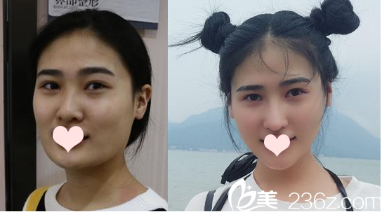 深圳德漾罗志敏隆鼻案例图