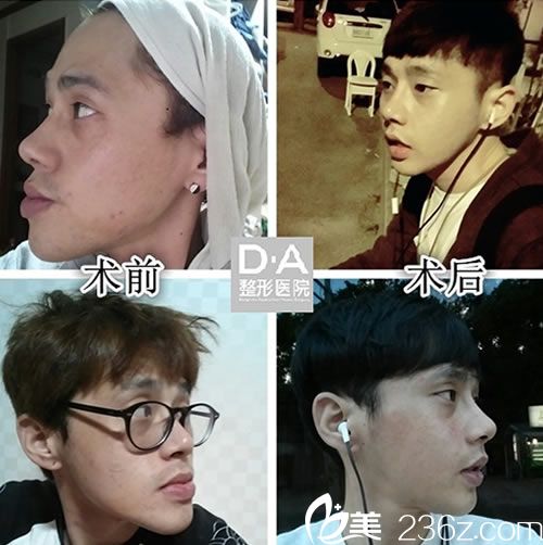 <!--<i data=20240703-sp></i>-->院长的面部轮廓案例 <!--<i data=20240703-sp></i>-->院长的面部轮廓案例