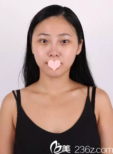 隆鼻术前照片 隆鼻术前照片