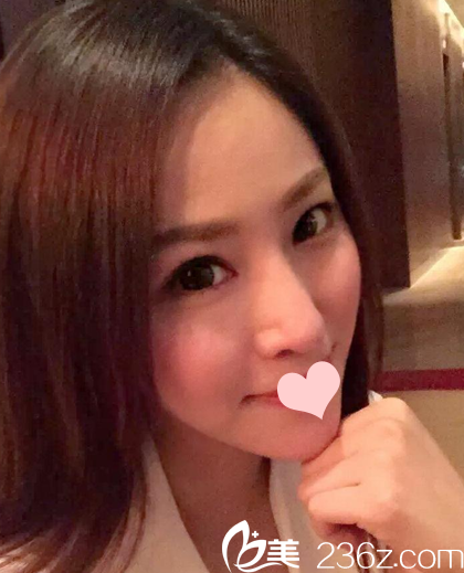 找罗志敏医生做完鼻综合术后37天自拍 找罗志敏医生做完鼻综合术后37天自拍