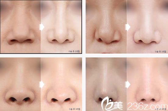 崔珉硕院长的隆鼻案例