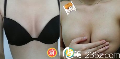 金起甲院长做假体隆胸案例 金起甲院长做假体隆胸案例