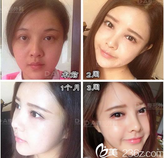 李炅默院长的眼鼻整形案例