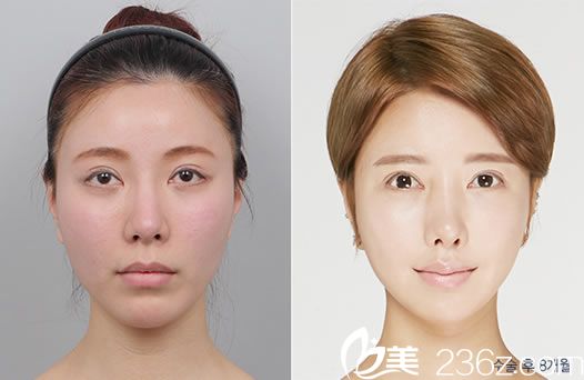 闵丙伊院长的皮肤美容案例