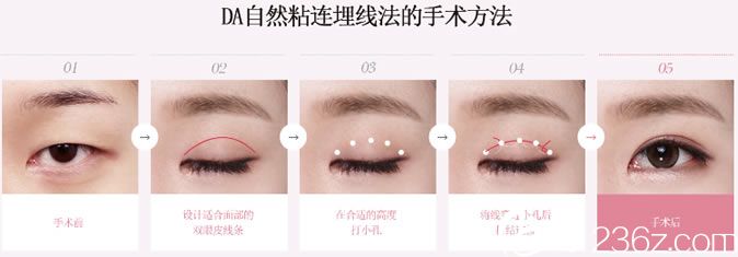 DA埋线双眼皮手术过程示意图
