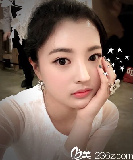 双眼皮开眼角手术8个月效果