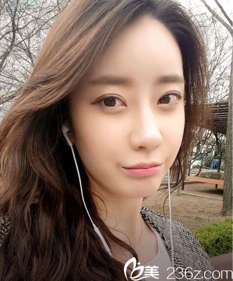 埋线双眼皮手术后5个月效果