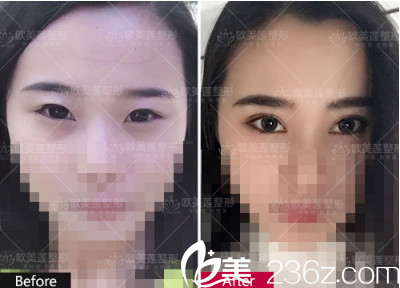 太原欧美莲高欢利医生双眼皮真实案例 太原欧美莲高欢利医生双眼皮真实案例