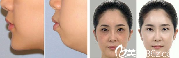 徐高淳院长微整形美肤案例