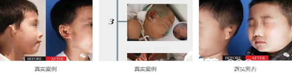 康春雨小耳再造真实案例