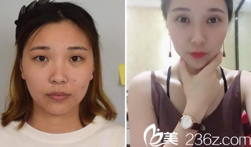 周宇丹院长的分切双眼皮案例 周宇丹院长的分切双眼皮案例