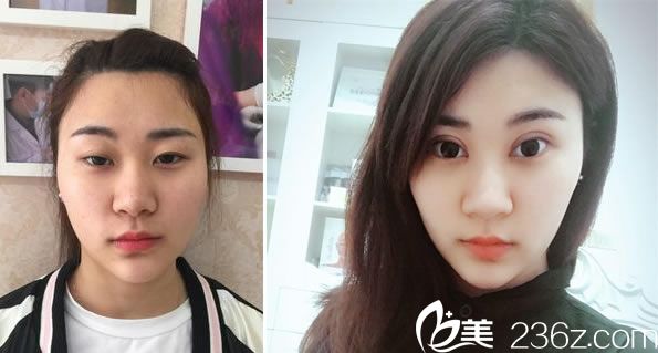 赵学燕医生做双眼皮怎么样 赵学燕医生做双眼皮怎么样