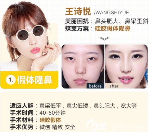 嘉兴禾美硅胶假体隆鼻案例 嘉兴禾美硅胶假体隆鼻案例