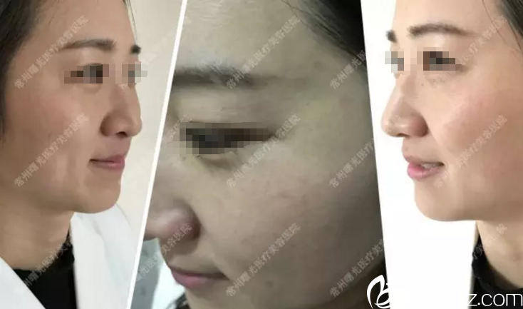 术前脸上干纹红血丝 术前脸上干纹红血丝