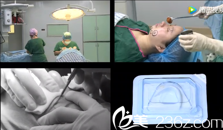 高亮美杜莎双眼皮+假体隆颏手术