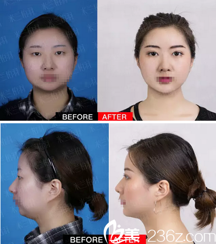 <!--<i data=20240703-sp></i>-->柏羽高亮双眼皮+假体隆颏手术对比照