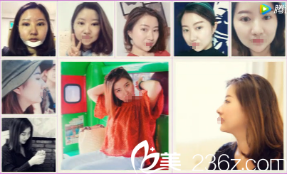 美杜莎双眼皮+假体隆颏术后恢复