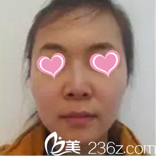 做鼻综合整形术前的样子 做鼻综合整形术前的样子