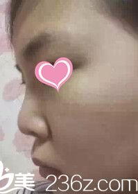 咬肌发达 咬肌发达