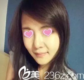 鼻综合手术15天鼻子慢慢恢复中 鼻综合手术15天鼻子慢慢恢复中