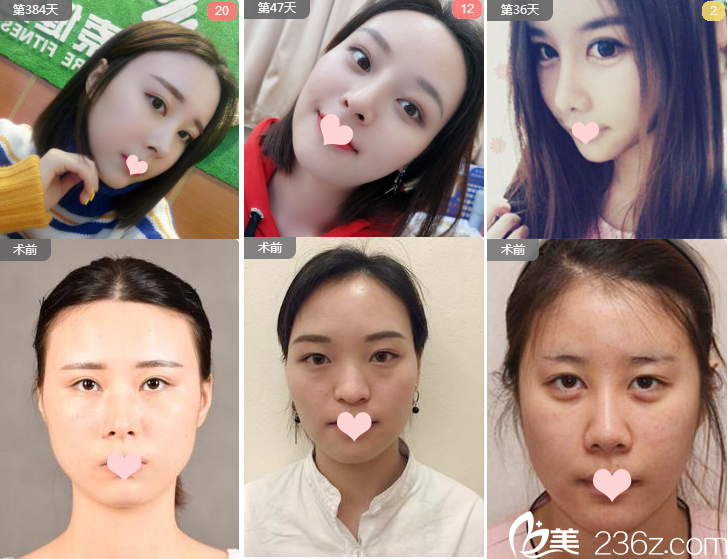 广州华美整形医院沈绍勇做过的隆鼻效果图