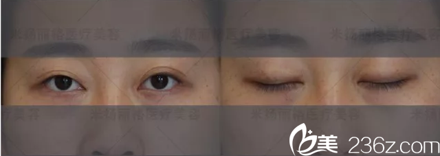 米扬丽格求美者眼睛分析 米扬丽格求美者眼睛分析