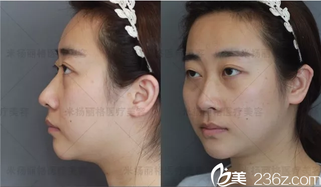 北京米扬丽格求美案例分析 北京米扬丽格求美案例分析