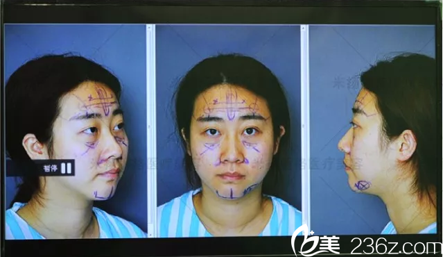 北京米扬丽格真人案例手术方案