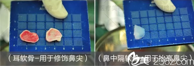 鼻综合手术方案 鼻综合手术方案