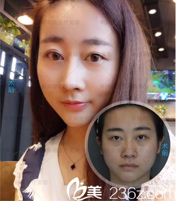 北京米扬丽格真人案例术后改变 北京米扬丽格真人案例术后改变