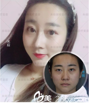 北京米扬丽格全脸填充加隆鼻真人案例